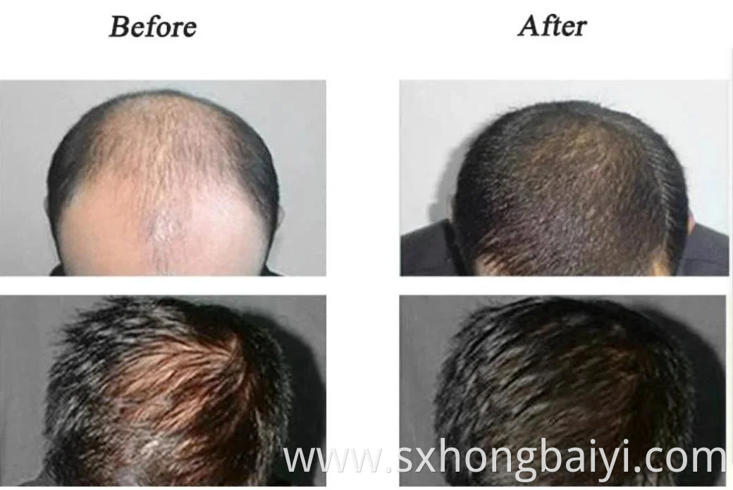 Anti Hair Loss Raw Material Pure Powder 99% Ru58841 Powder